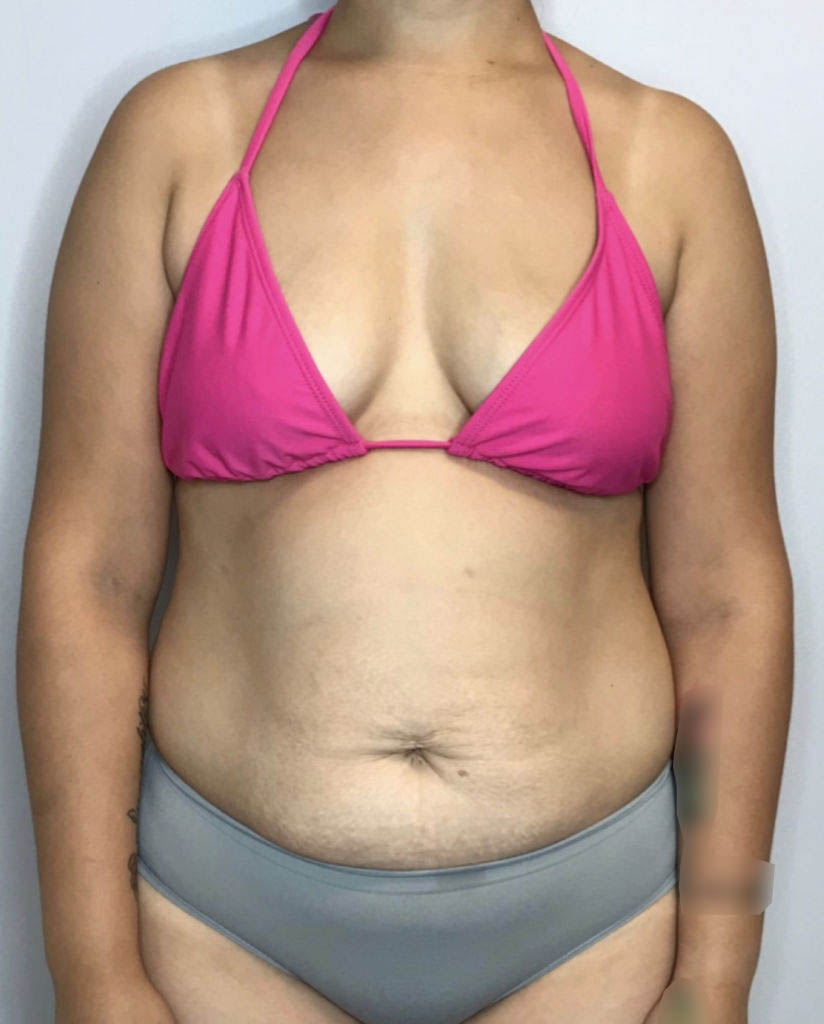 Mommy Makeover Before & After Patient #2184