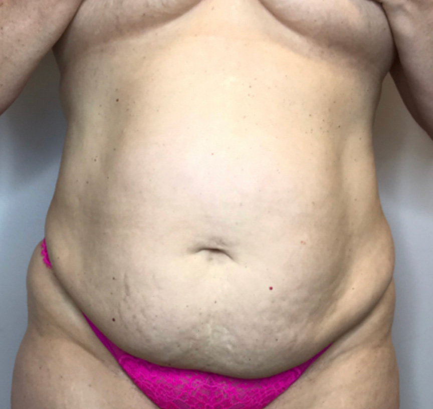 Liposuction Before & After Patient #2247