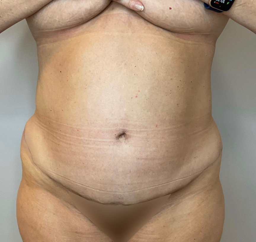 Liposuction Before & After Patient #2247