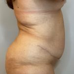 Liposuction Before & After Patient #2247