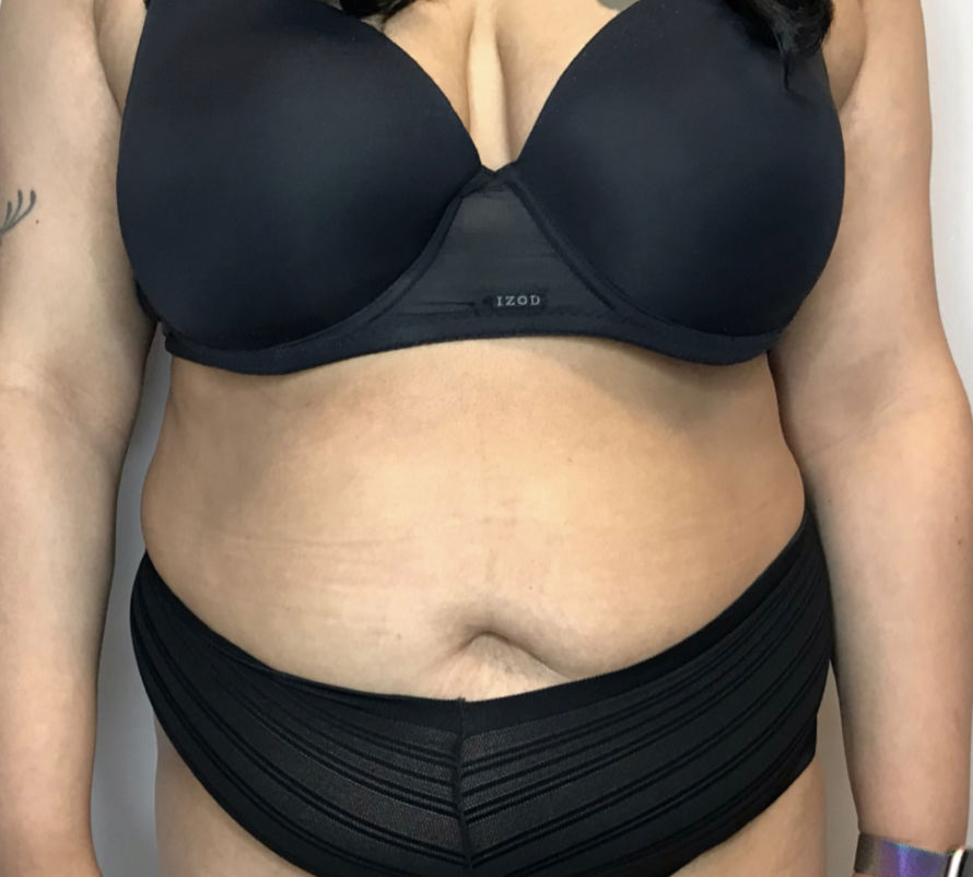 Liposuction Before & After Patient #2260