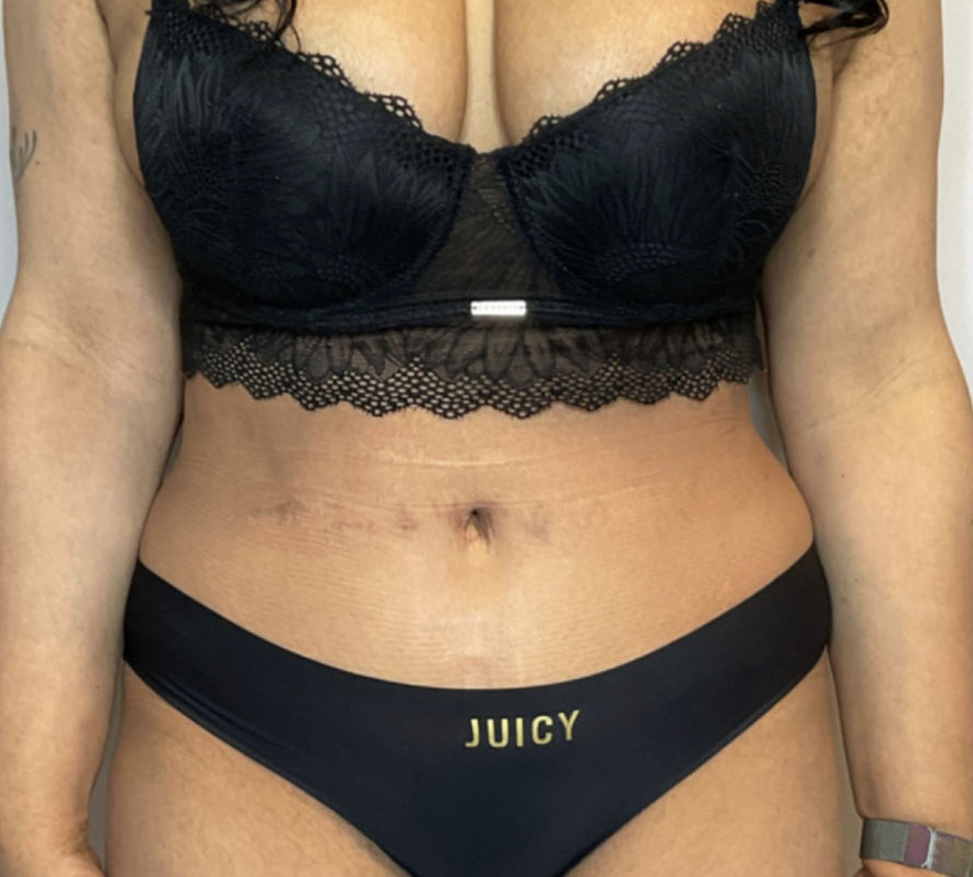 Liposuction Before & After Patient #2260