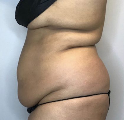 Liposuction Before & After Patient #2260