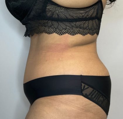 Liposuction Before & After Patient #2260