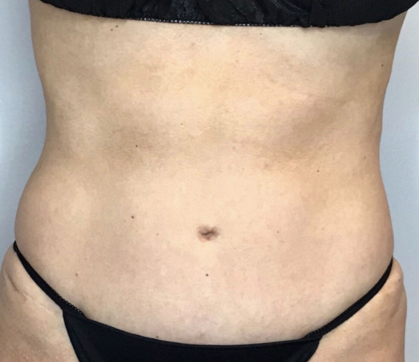 Liposuction Before & After Patient #2277