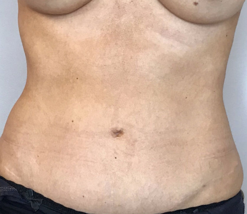 Liposuction Before & After Patient #2277
