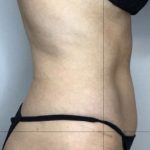 Liposuction Before & After Patient #2277