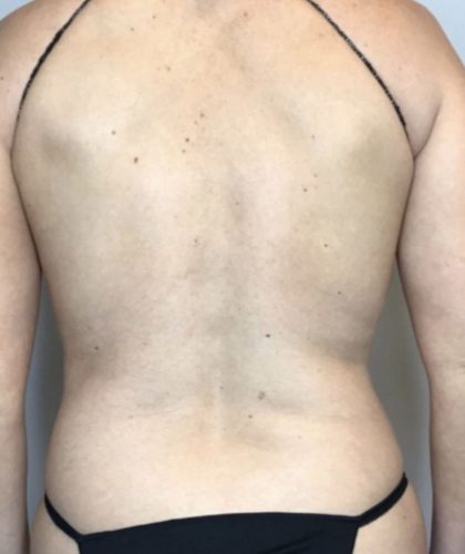 Liposuction Before & After Patient #2277