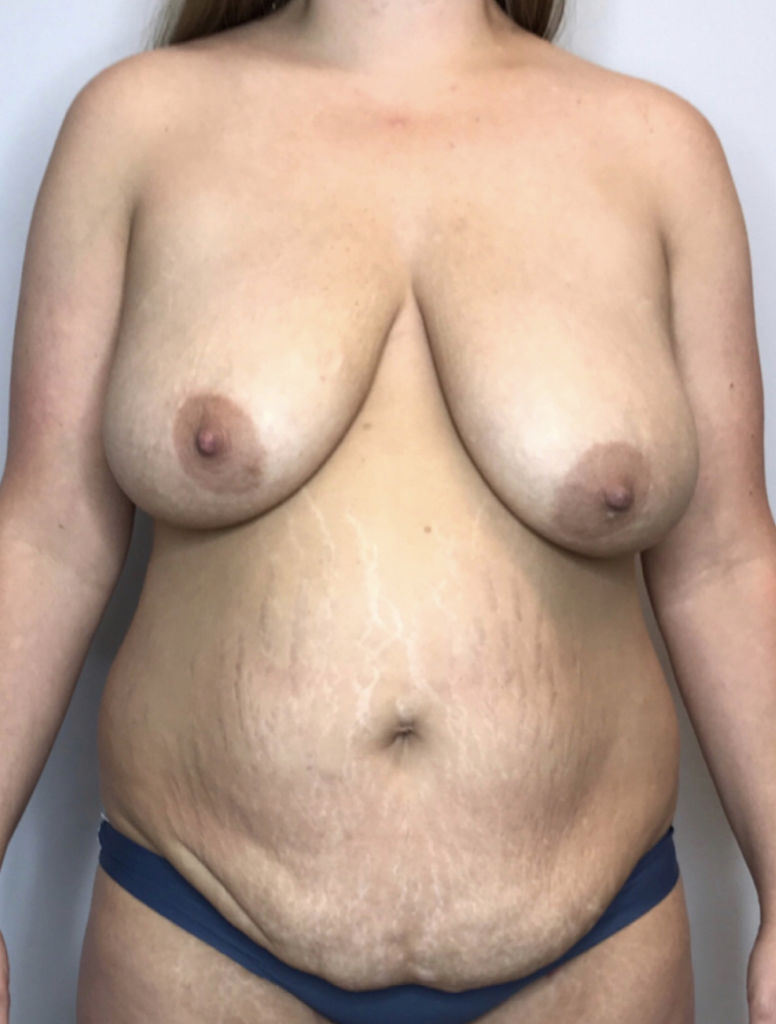 Mommy Makeover Before & After Patient #2285