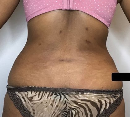 Liposuction Before & After Patient #2304