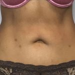 Liposuction Before & After Patient #2304