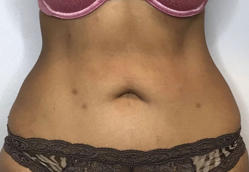 Liposuction Before & After Patient #2304