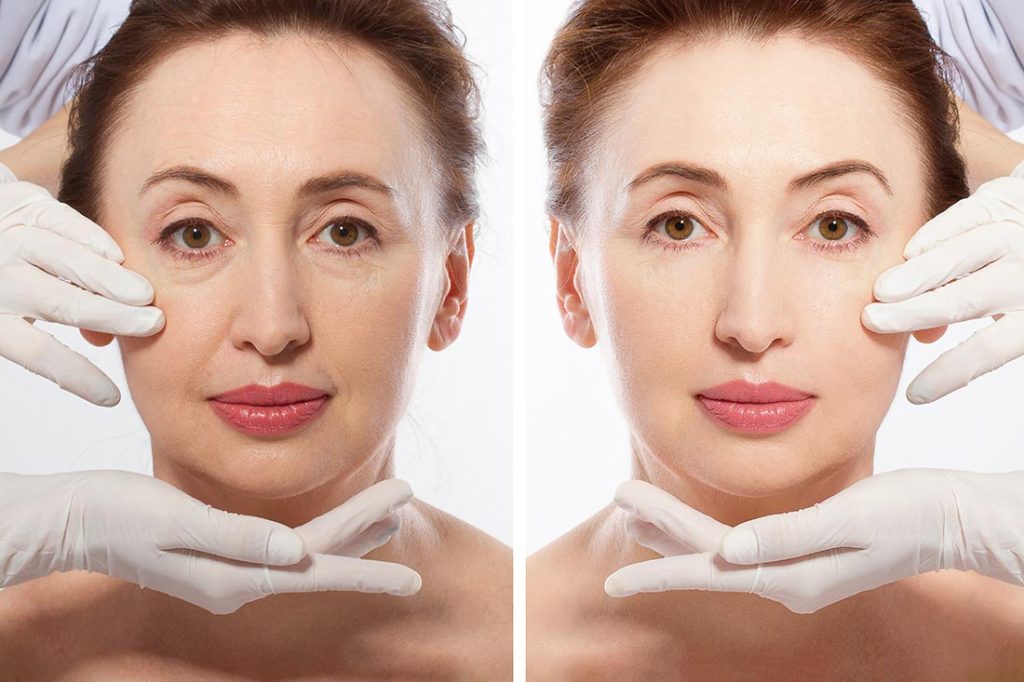 Before and after showing woman with eyelids lifted.  Alen Aesthetic Surgery.