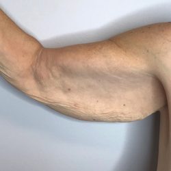 Brachioplasty Before & After Patient #2615