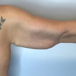 Brachioplasty Before & After Patient #2624