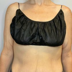 Brachioplasty Before & After Patient #2705