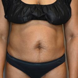 Tummy Tuck Before & After Patient #2716
