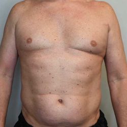 Renuvion Skin Tightening Before & After Patient #2751