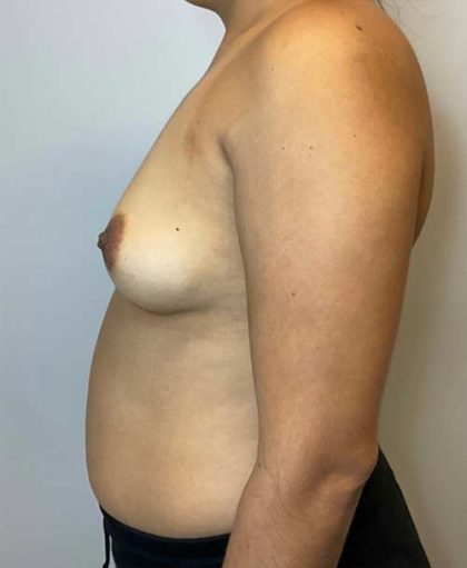 Breast Augmentation Before & After Patient #2727