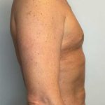 Renuvion Skin Tightening Before & After Patient #2751