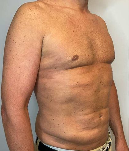 Renuvion Skin Tightening Before & After Patient #2751