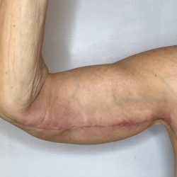 Brachioplasty Before & After Patient #2615