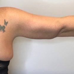 Brachioplasty Before & After Patient #2624