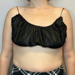 Brachioplasty Before & After Patient #2705