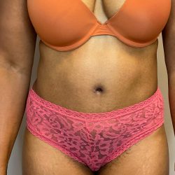 Tummy Tuck Before & After Patient #2716