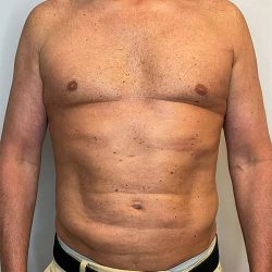 Renuvion Skin Tightening Before & After Patient #2751