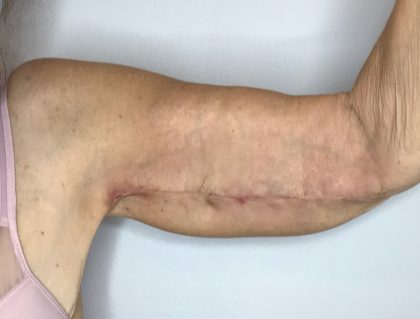 Brachioplasty Before & After Patient #2615