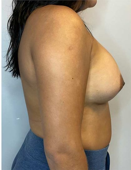 Breast Augmentation Before & After Patient #2727
