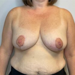Breast Reduction Before & After Patient #2740