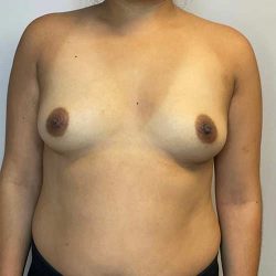 Breast Augmentation Before & After Patient #2727