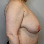Breast Reduction Before & After Patient #2740
