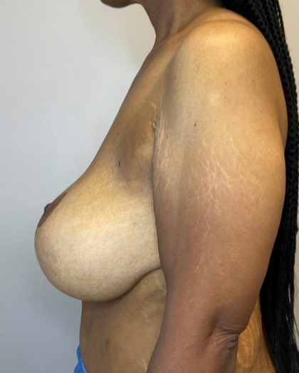 Breast Augmentation Before & After Patient #2604