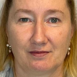 Blepharoplasty Before & After Patient #2691