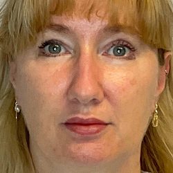 Blepharoplasty Before & After Patient #2691