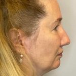 Blepharoplasty Before & After Patient #2691