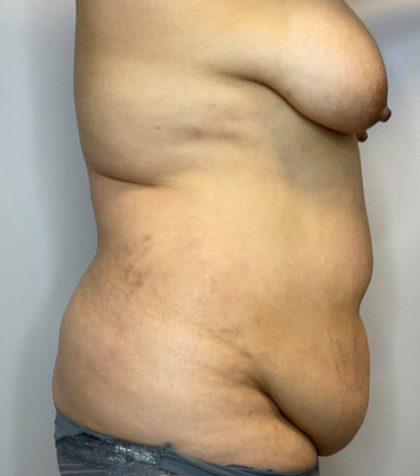 Liposuction Before & After Patient #2650