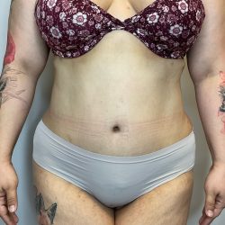 Liposuction Before & After Patient #2650