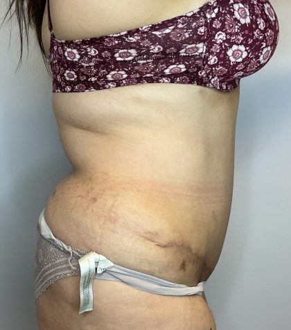 Liposuction Before & After Patient #2650