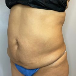 Liposuction Before & After Patient #2633
