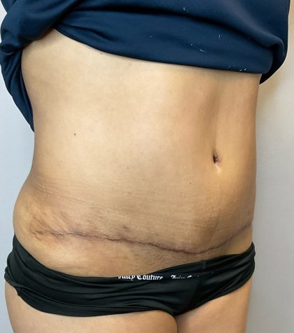 Liposuction Before & After Patient #2633