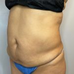 Liposuction Before & After Patient #2633