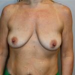 Breast Augmentation Before & After Patient #2982