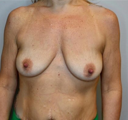 Breast Augmentation Before & After Patient #2982