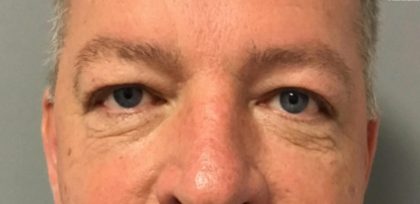 Blepharoplasty Before & After Patient #2994