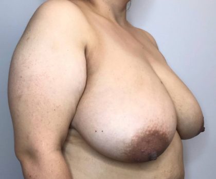 Breast Reduction Before & After Patient #3002