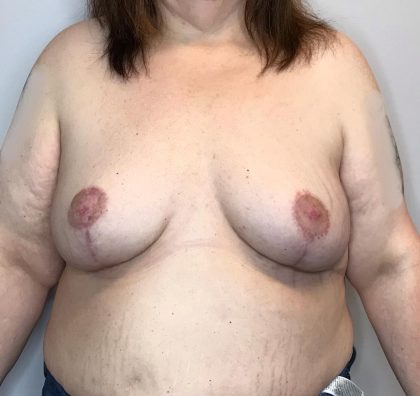 Breast Lift Before & After Patient #2949